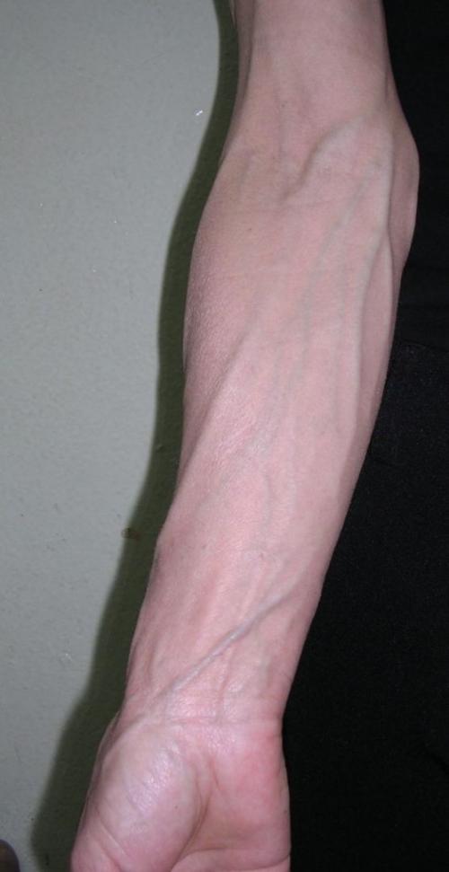 Вздутие вен на руках. Классификация и стадии развития флебита 01