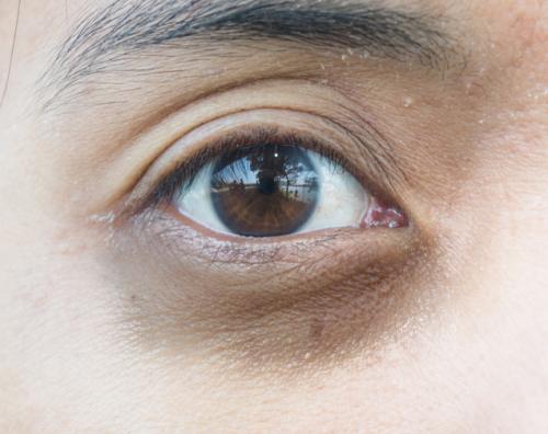 Лучшее средство от темных кругов под глазами. Давайте взглянем на анатомическое строение области глаз.