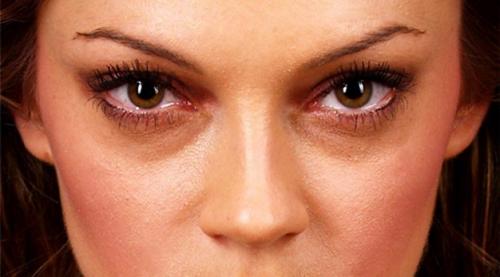 Убрать темные круги синяки мешки под глазами. Домашние тактики борьбы со стойкими синяками под глазами 07 Убрать темные круги синяки мешки под глазами. Домашние тактики борьбы со стойкими синяками под глазами 07