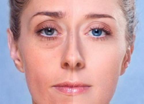 Как бороться с темными кругами под глазами. Причины появления темных кругов под нижнем веком 10