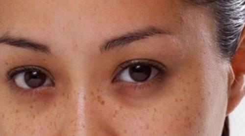 Как бороться с темными кругами под глазами. Причины появления темных кругов под нижнем веком 19