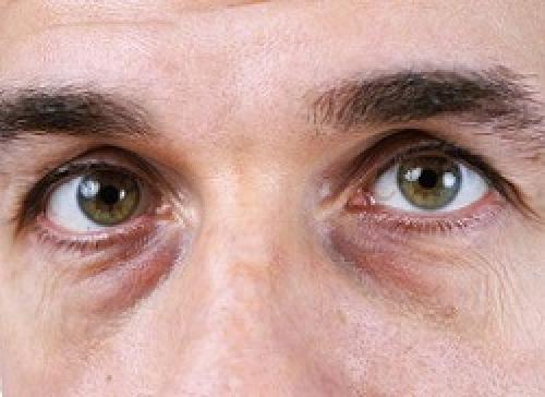 Как бороться с темными кругами под глазами. Причины появления темных кругов под нижнем веком 09