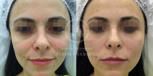 Как избавиться от темных кругов под глазами косметология. Разбираемся в причинах проблемы.