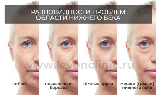 Коррекция темных кругов под глазами. Почему появляются синяки и круги под глазами? 02 Коррекция темных кругов под глазами. Почему появляются синяки и круги под глазами? 02