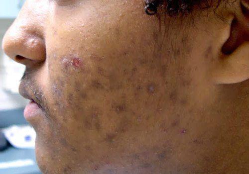 Как убрать пигментные пятна. Пигментация лица: как убрать 06