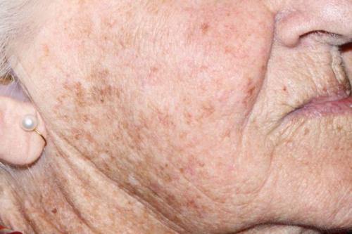 Как убрать пигментные пятна. Пигментация лица: как убрать 08