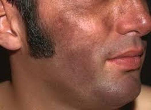 Как убрать пигментные пятна. Пигментация лица: как убрать 10