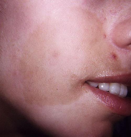 Как убрать пигментные пятна. Пигментация лица: как убрать 09