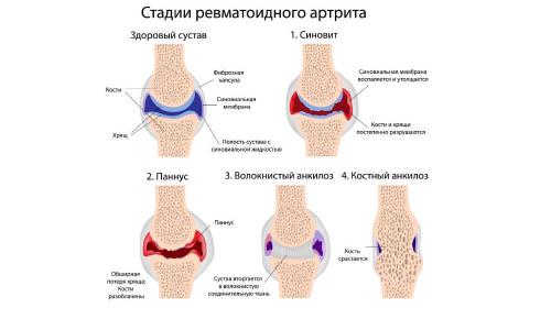 Какие вещества содержит желатин и как они влияют на суставы и связки. Польза желатина для суставов