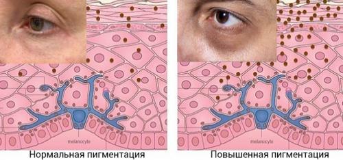 Убрать темные круги вокруг глаз. Причины появления темных кругов под глазами 14