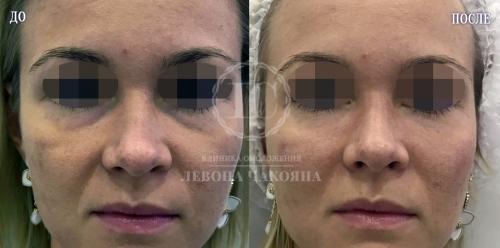 Как осветлить пигментацию вокруг глаз. Разбираемся в причинах проблемы.