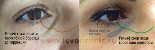 Средство от темных кругов под глазами в домашних условиях. Реально работающие способы убрать тёмные круги.