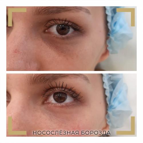 Как осветлить пигментацию вокруг глаз. Разбираемся в причинах проблемы.