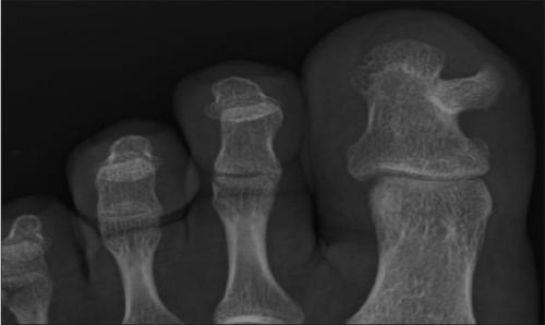 Шишка на па суставе мизинца. Как лечиться, если болит шишка на большом пальце 04