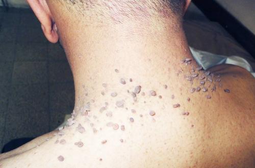 Виды бородавок и причины их появления. Почему появляются бородавки и какими они бывают 07