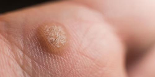 Виды бородавок и причины их появления. Почему появляются бородавки и какими они бывают 01