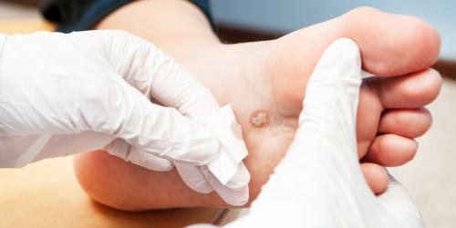 Виды бородавок и причины их появления. Почему появляются бородавки и какими они бывают 02