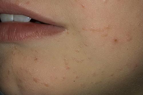 Виды бородавок и причины их появления. Почему появляются бородавки и какими они бывают 04