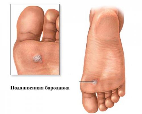 Виды бородавок и причины их появления. Почему появляются бородавки и какими они бывают 05