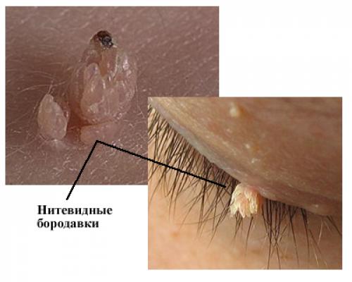 Виды бородавок и причины их появления. Почему появляются бородавки и какими они бывают 06