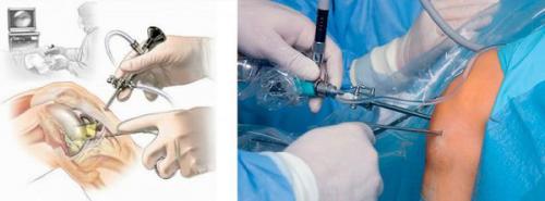 Бурсит пальцев и кистей рук. Бурсит кисти 01 Бурсит пальцев и кистей рук. Бурсит кисти 01