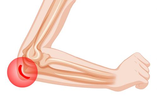 Бурсит пальцев и кистей рук. Бурсит кисти 03 Бурсит пальцев и кистей рук. Бурсит кисти 03