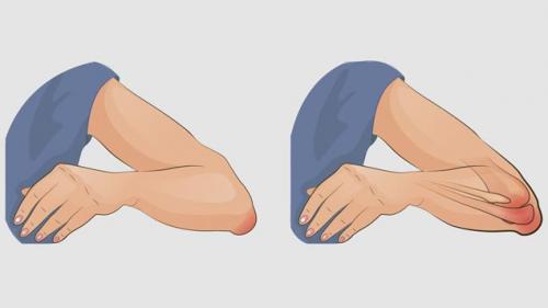 Бурсит пальцев и кистей рук. Бурсит кисти 02 Бурсит пальцев и кистей рук. Бурсит кисти 02