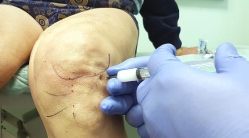 Внутрисуставные инъекции под контролем УЗИ. Кому показаны внутрисуставные инъекции 02 Внутрисуставные инъекции под контролем УЗИ. Кому показаны внутрисуставные инъекции 02