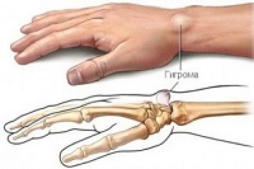 Удаление гигромы на руке. Удаление гигромы 01