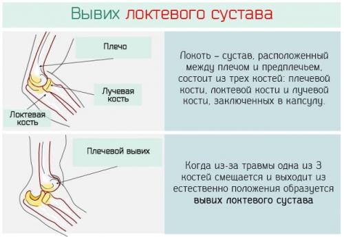 Реабилитация после вывиха локтевого сустава. Вывих локтевого сустава: лечение, последствия и первая помощь