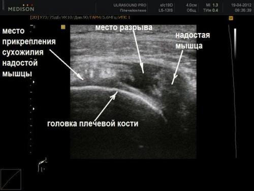 Суставы и сухожилия плеча: как сохранить здоровье и избежать травм 01 Суставы и сухожилия плеча: как сохранить здоровье и избежать травм 01