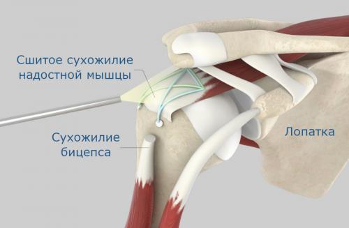 Все, что нужно знать о повреждении вращательной манжеты плеча 02 Все, что нужно знать о повреждении вращательной манжеты плеча 02