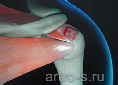 Все, что нужно знать о повреждении вращательной манжеты плеча 08 Все, что нужно знать о повреждении вращательной манжеты плеча 08