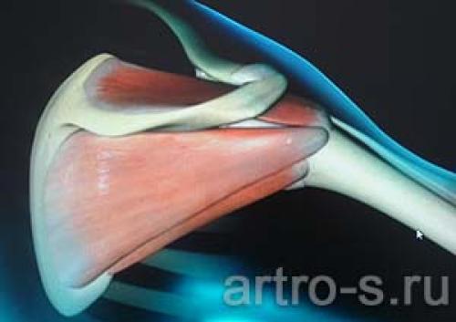 Все, что нужно знать о повреждении вращательной манжеты плеча 07 Все, что нужно знать о повреждении вращательной манжеты плеча 07