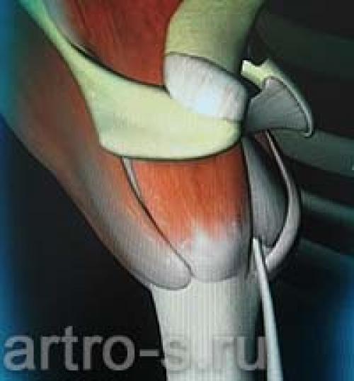 Все, что нужно знать о повреждении вращательной манжеты плеча 06 Все, что нужно знать о повреждении вращательной манжеты плеча 06