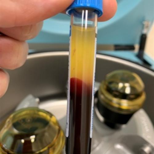 Уколы гиалуроновой кислоты в сустав. О чем расскажет молекулярная масса 03 Уколы гиалуроновой кислоты в сустав. О чем расскажет молекулярная масса 03