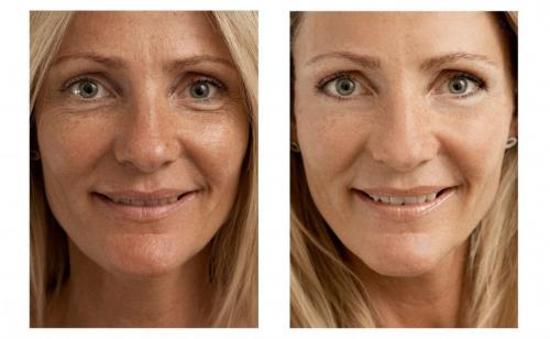 Уколы гиалуроновой кислоты побочные эффекты. Что такое биоревитализация лица и ее эффективность