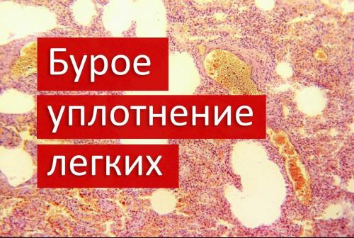 Какие области тела чаще всего подвержены появлению уплотнений. Инфильтрат: виды, симптомы и лечение