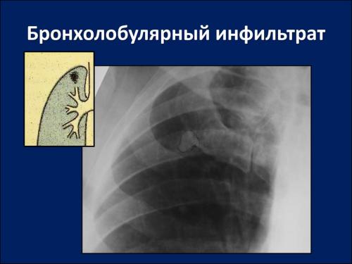 Какие области тела чаще всего подвержены появлению уплотнений. Инфильтрат: виды, симптомы и лечение