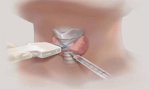 Могут ли уплотнения исчезнуть без медицинского вмешательства. Как должны лечиться узлы?