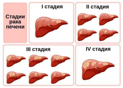 Кисты печени и Доброкачественные опухоли печени. Киста правой доли печени 01