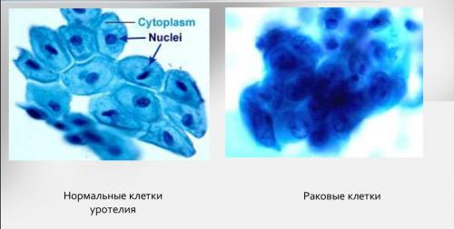 Что такое доброкачественная опухоль. Лечение доброкачественных новообразований 02 Что такое доброкачественная опухоль. Лечение доброкачественных новообразований 02