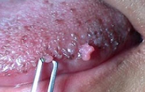 Удаление доброкачественных новообразований слизистой. Виды доброкачественных заболеваний вульвы 02