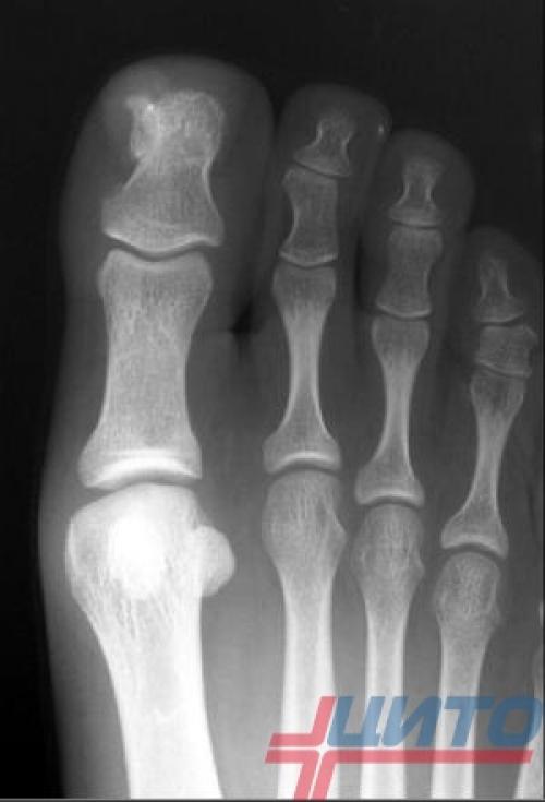 Нарост на фаланге указательного пальца: причины и лечение 02 Нарост на фаланге указательного пальца: причины и лечение 02