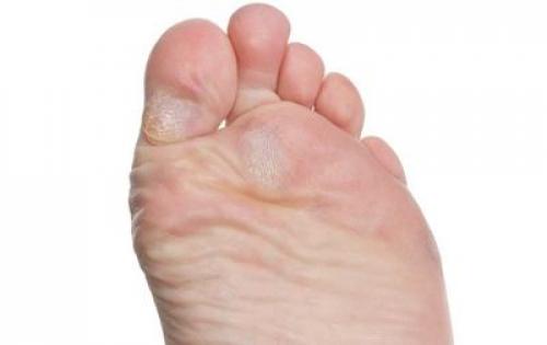 Почему высыпания на коже могут возникать при сахарном диабете 04