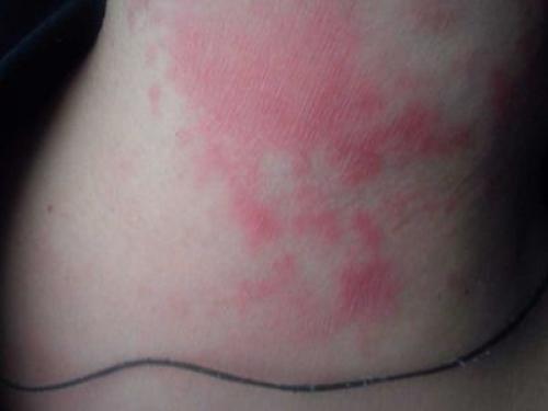 Почему высыпания на коже могут возникать при сахарном диабете 02