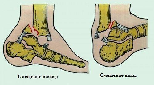 Травмы области голеностопного сустава и стопы. Травма голеностопного сустава: методы диагностики и лечения