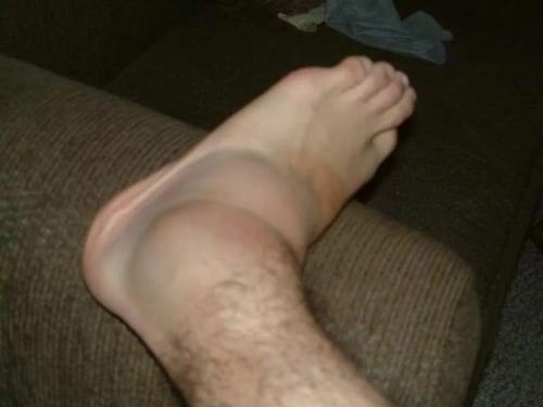 Травмы области голеностопного сустава и стопы. Травма голеностопного сустава: методы диагностики и лечения