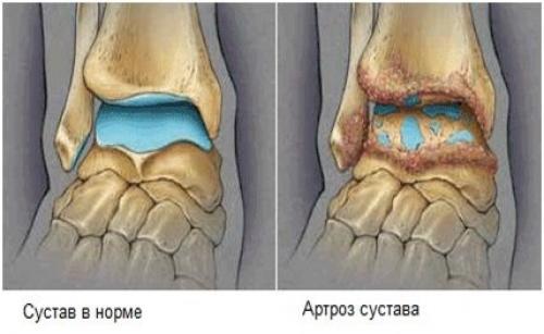 Травмы области голеностопного сустава и стопы. Травма голеностопного сустава: методы диагностики и лечения