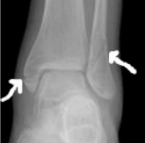 Травмы области голеностопного сустава и стопы. Травма голеностопного сустава: методы диагностики и лечения
